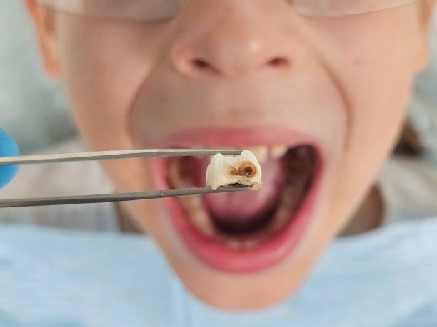 Best Dental Abscess Treatment in Burlington, CO
